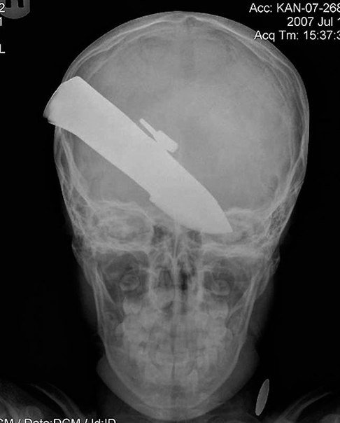 Las radiografías más extrañas de la historia de la medicina. - 5