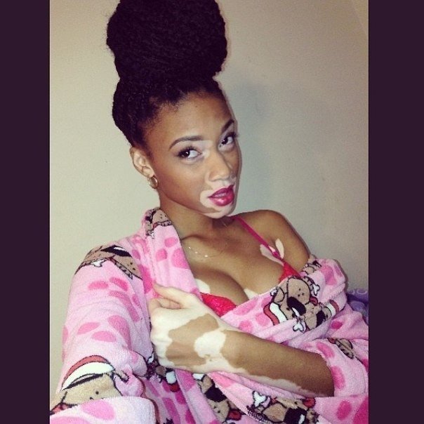 Шантель Винни - американская модель с нарушением пигментации кожи. Шантель Винни - 19-летняя модель подающая надежды, родом из Торонто. Её отличительной особенностью является болезнь витилиго, характеризующаяся нарушением пигментации кожи. Эта харизматичн - 5