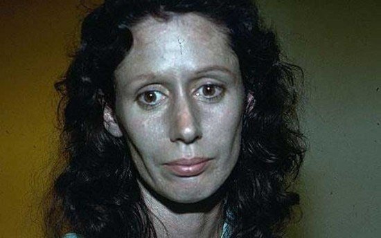 У 71-летней Розмари Джейкобс серебристая кожа вот уже на протяжении 60 прошлых лет. Когда ей было 11 лет, у нее развилось редкое заболевание – аргироз, вызванное воздействием химических форм серебра, которое делает кожу синей или синевато-серой. У Розмари