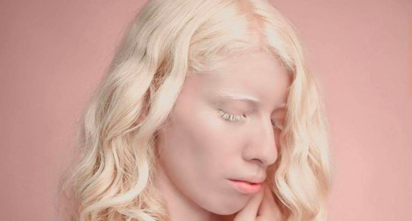 Как выглядят альбиносы разных рас