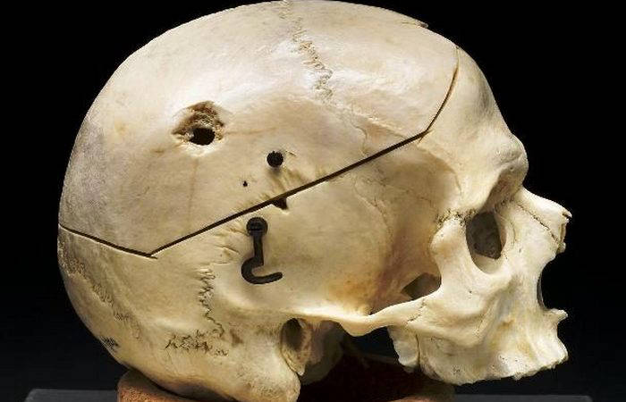 Gunshot wound: infection. Gunshot wound: infections.